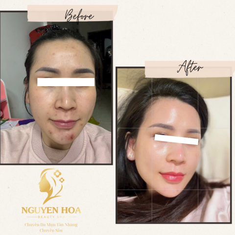 Da Mụn